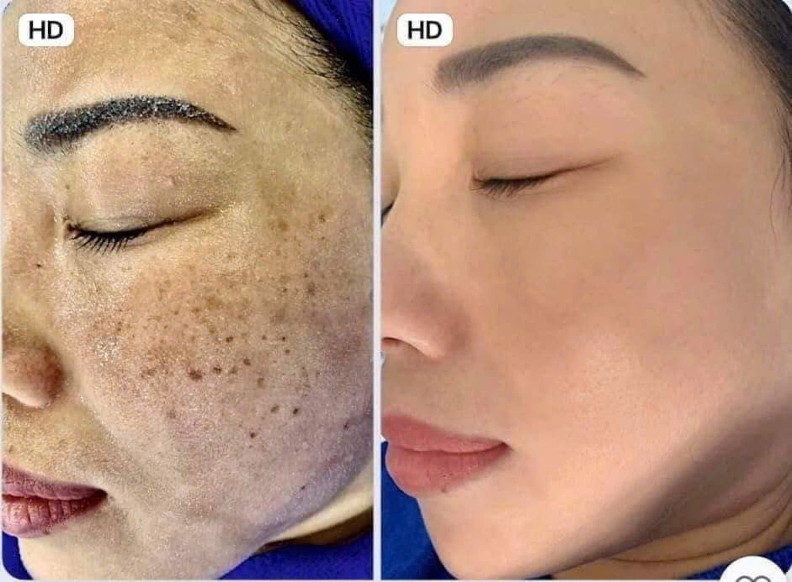 spa trị nám
