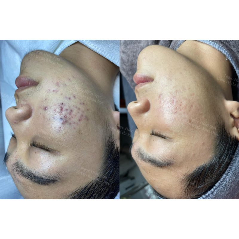 Điều trị mụn