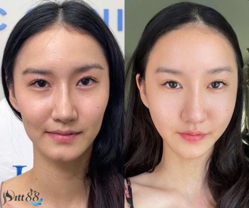 tiêm filler cằm