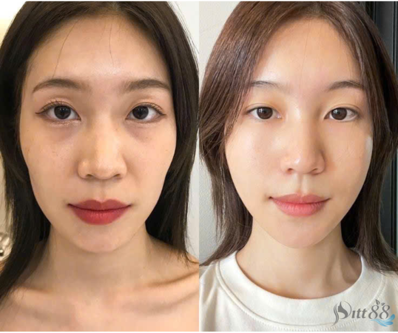 Cân chỉnh cằm phong thủy