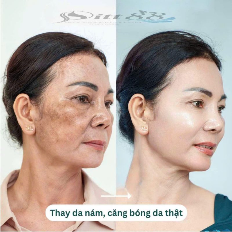 spa trị nám
