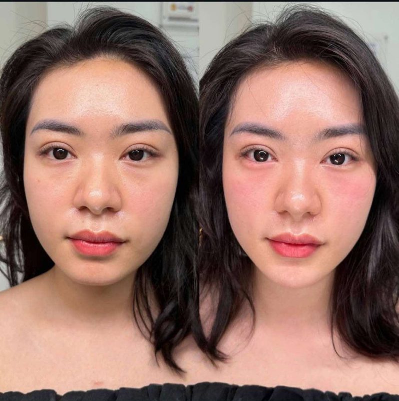 tiêm thon gọn mặt