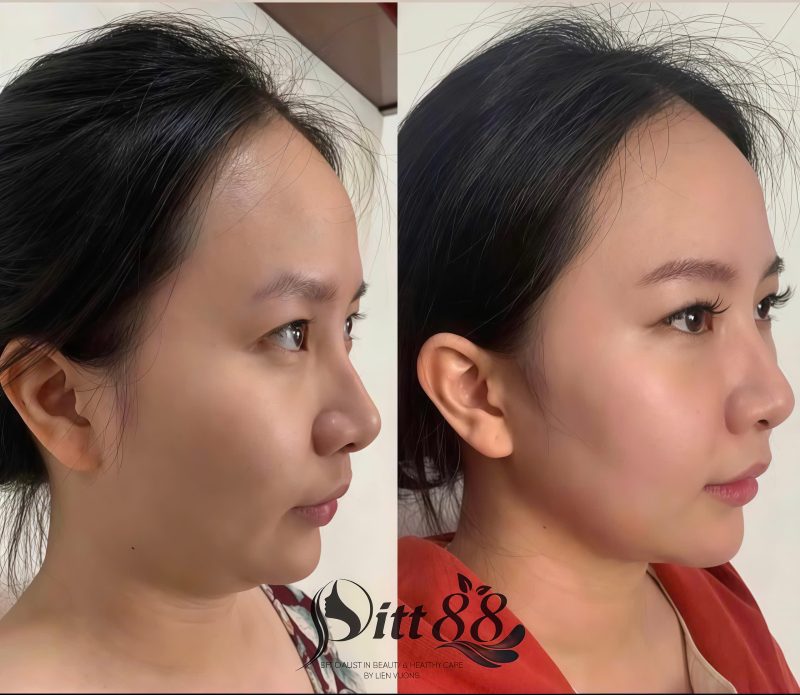 tiêm tan mỡ nọng cằm