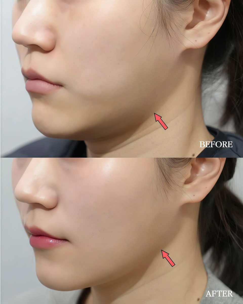 tiêm cằm filler tự nhiên Bình Dương