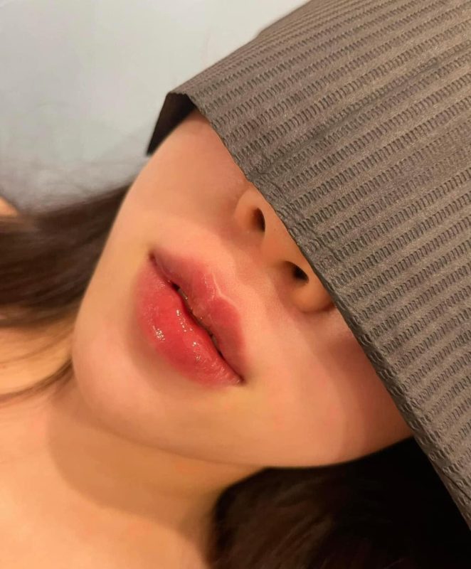 phun môi collagen