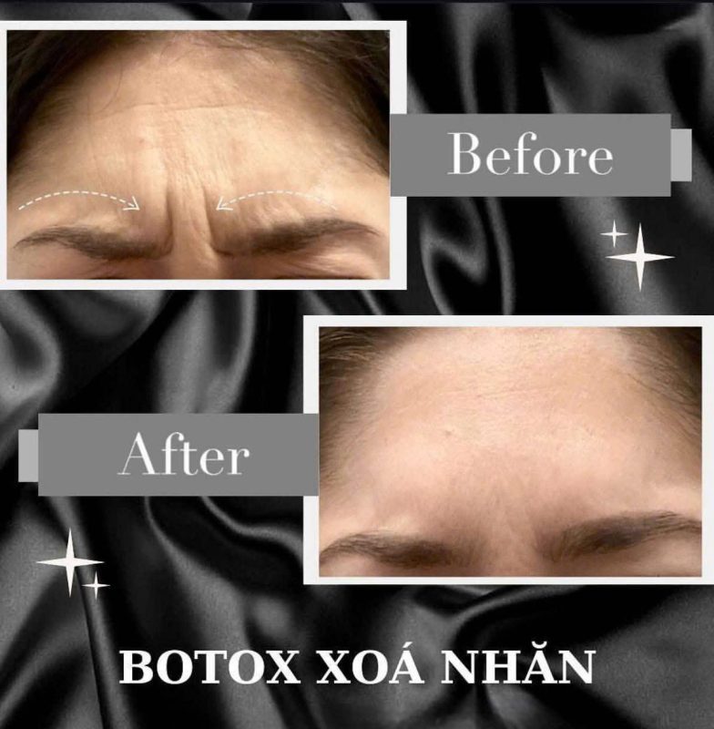 xóa nhăn