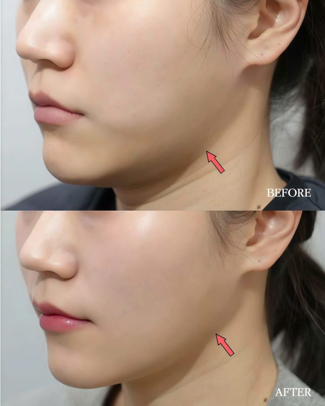spa tiêm tan mỡ